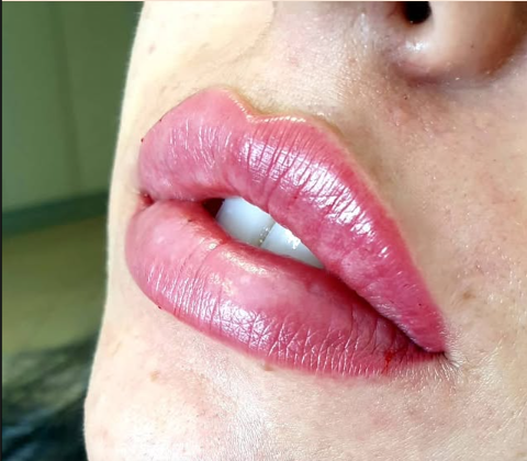 עיצוב ומילוי שפתיים