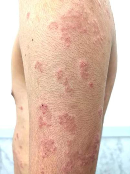 สะเก็ดเงิน2.jpg