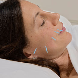 Cosmetic acupuncture.jpg