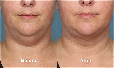 Kybella-Before-After-9-1 (1).jpg