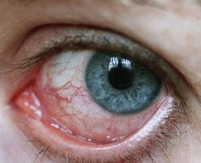 sindrome s_edited.jpg