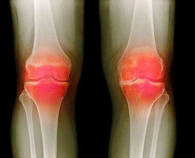 artrosis_rodilla.jpg