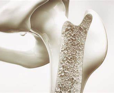 Osteoporose.jpg