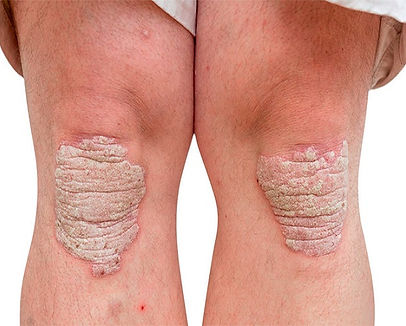 Artrite Psoriásica.jpg