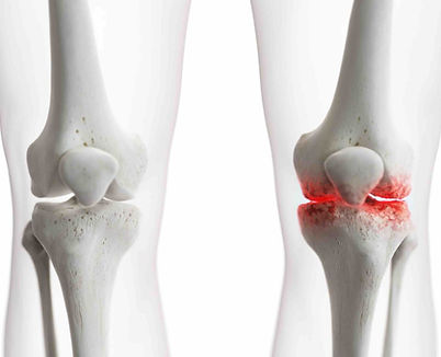 Osteoartrose (artrose).jpg