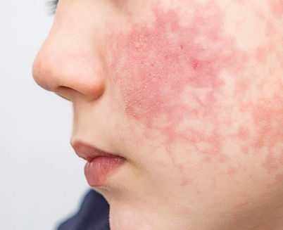 lupus-o-que-e.jpg