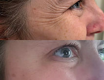 Crows Feet