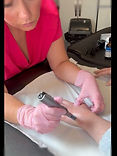 Microneedling