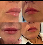 Lips