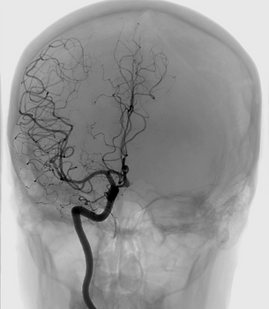 Cerebral Angiogram.png