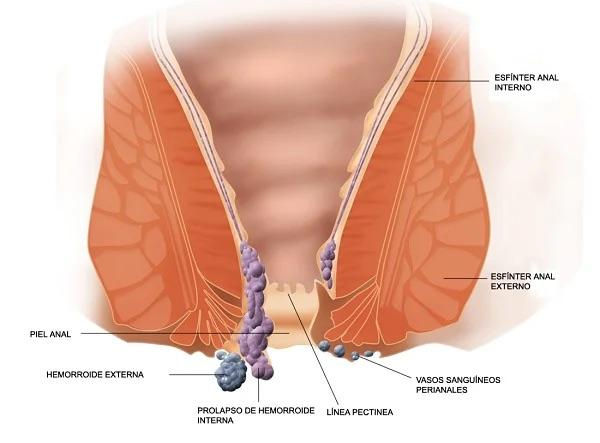 HEMORROIDES.jpg