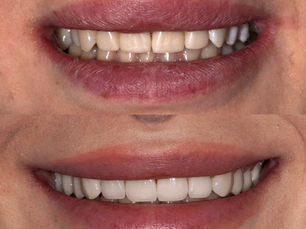 Cât costă fațetele dentare în 2025 – tipuri și prețuri