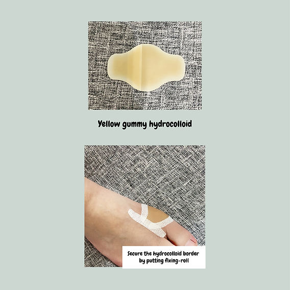 Dressing for De-roof blister (hydrocolloid) Dressing for De-roof blister (hydrocolloid)