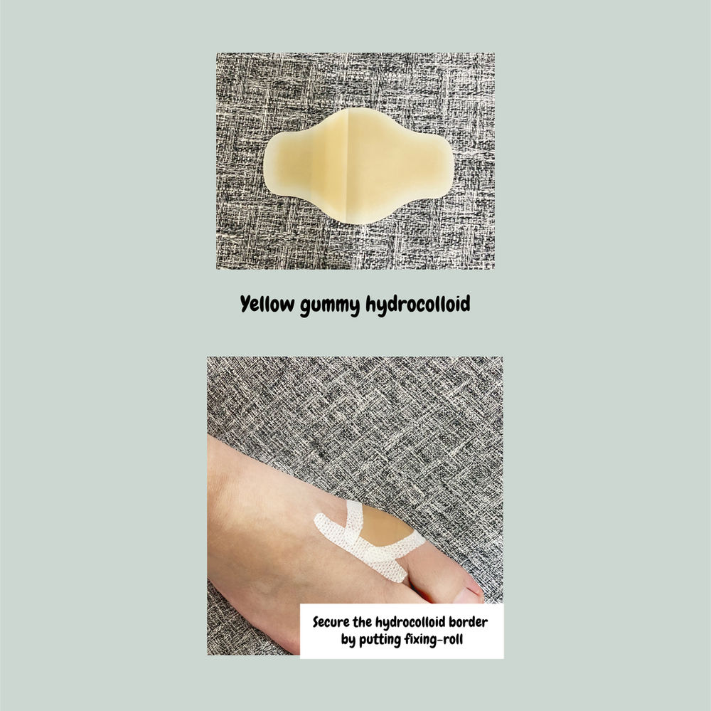 Dressing for Deroof blister (hydrocolloid)
