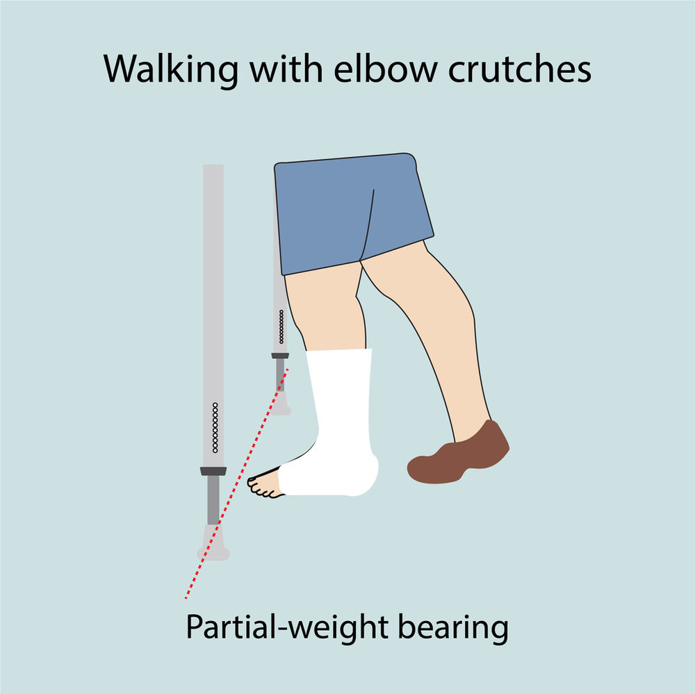 All you want to know about crutches forearm and underarm crutches