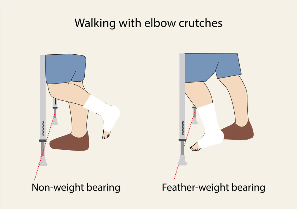 All you want to know about crutches forearm and underarm crutches