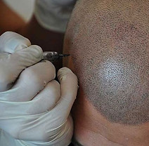 dermopigmentation capillaire