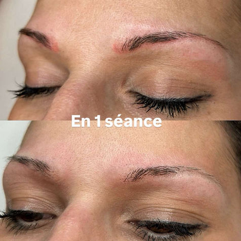 détatouage sourcils