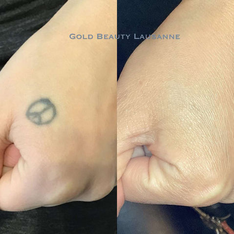 Détatouage Lausanne