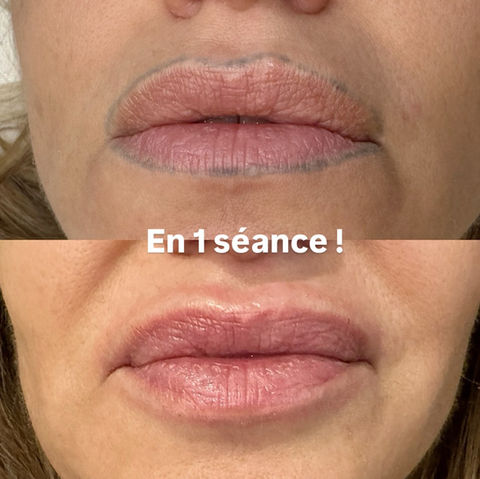 Détatouage des lèvres