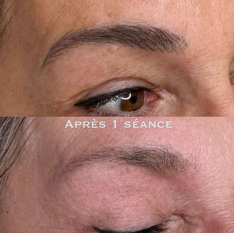 Enlever un microblading, détatouage sourcils