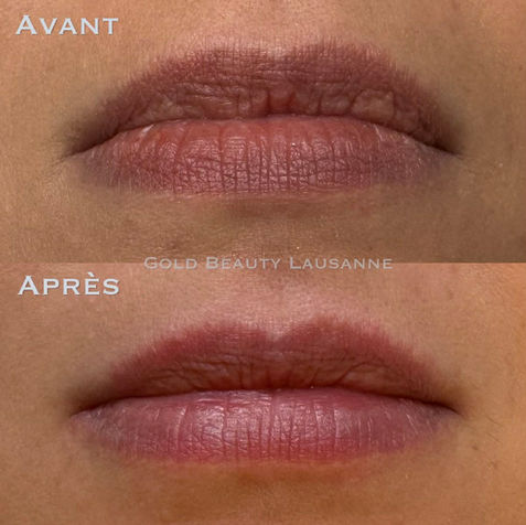éclaircissement lèvres foncées au laser