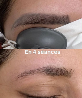 détatouage sourcils lausanne
