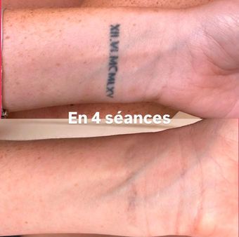 Détatouage Lausanne au laser picoseconde