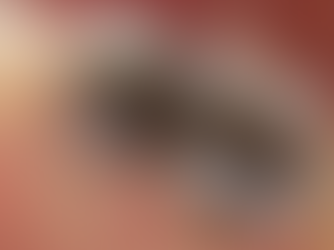 The Hidden Risks of Mercury in Dental Amalgams and the Smart Protocol for Safe Removal