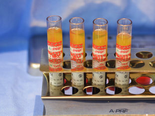 Understanding the Advantages of PRF in Dental Surgery for Extractions, Bone Grafts, and Implants