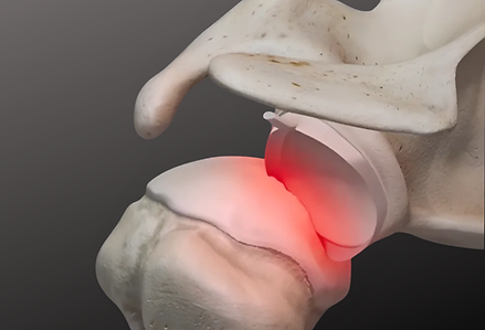 luxação do ombro, também conhecida como instabilidade do ombro