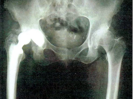 Il fallimento di una protesi all'anca: cause