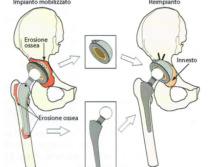 L’intervento di reimpianto