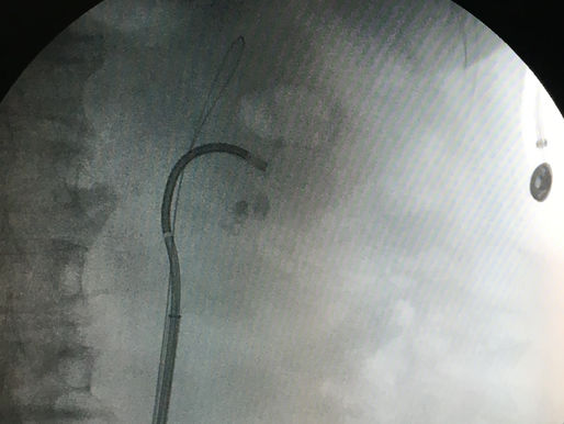 RIRS case after impacted renal stones w/ PCNL