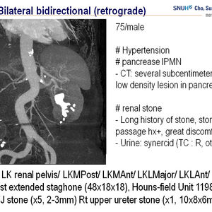 [Video guide 2017] Bidirectional ECIRS/supine PCNL + RIRS