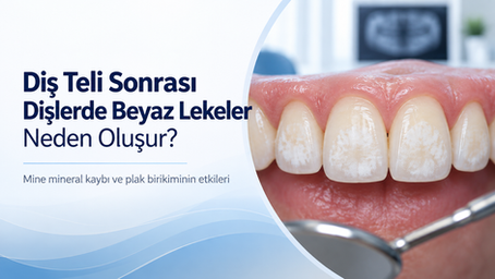 Diş teli tedavisi sonrası diş minesinde oluşan beyaz lekeleri ve mineral kaybını gösteren dental blog görseli.