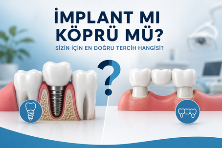 eksik diş tedavisinde implant mı köprü mü tercih edilmeli diş implantı ve diş köprüsü karşılaştırması modern diş kliniği görseli