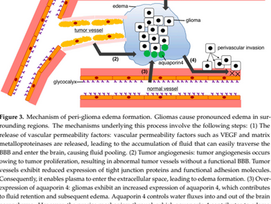 Peritumoral Edema in Gliomas: A Review of Mechanisms and Management