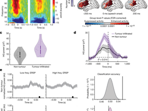 Glioblastoma remodelling of human neural circuits decreases survival