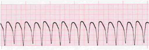 Ventricular Tachycardia (V-Tach)