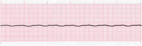 We Don't Shock Asystole (Flatline)