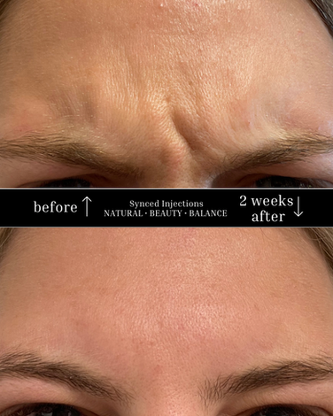 Botox Treatment: Forehead. Treatment #2