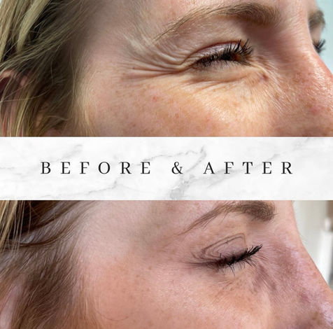 Botox Treatment: Crows B.A -1 