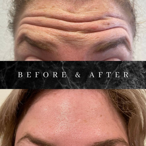 Botox Treatment: Frontalis B.A -1