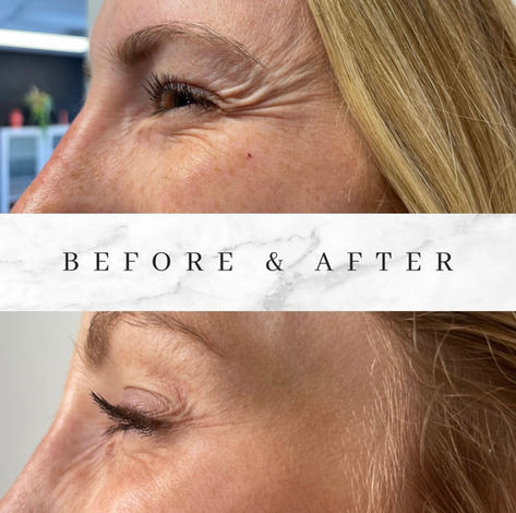 Botox Treatment: Crows B.A -2