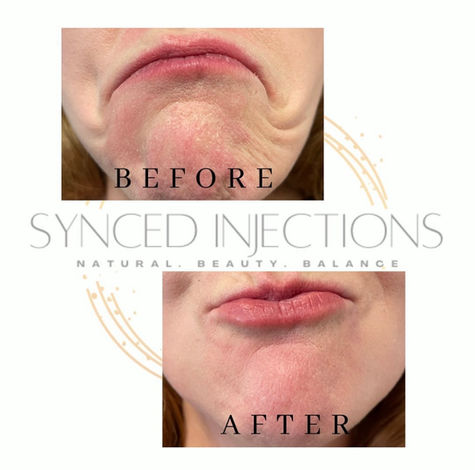 Botox Treatment: DAO B.A -1
