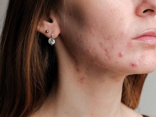 3 Myths and a Truth about Chemical Peels for Acne
