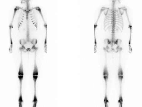 هشاشة العظام