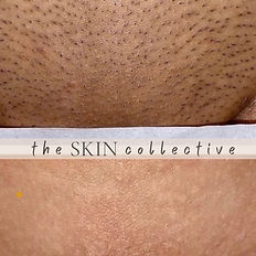 Laser hair removal in portsmouth at the skin collective