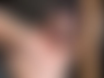 Agrandamiento de la Próstata: Conociendo los Síntomas y Opciones de Tratamiento